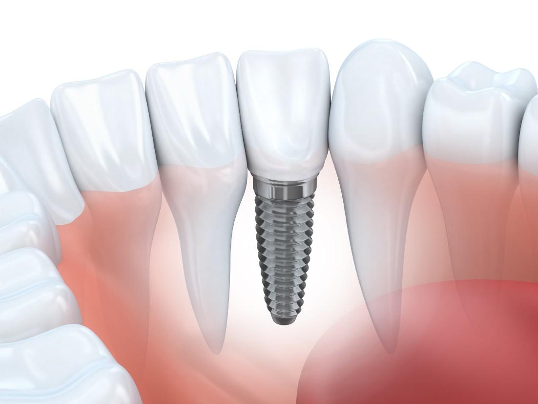 Dental Implants Milpitas, CA